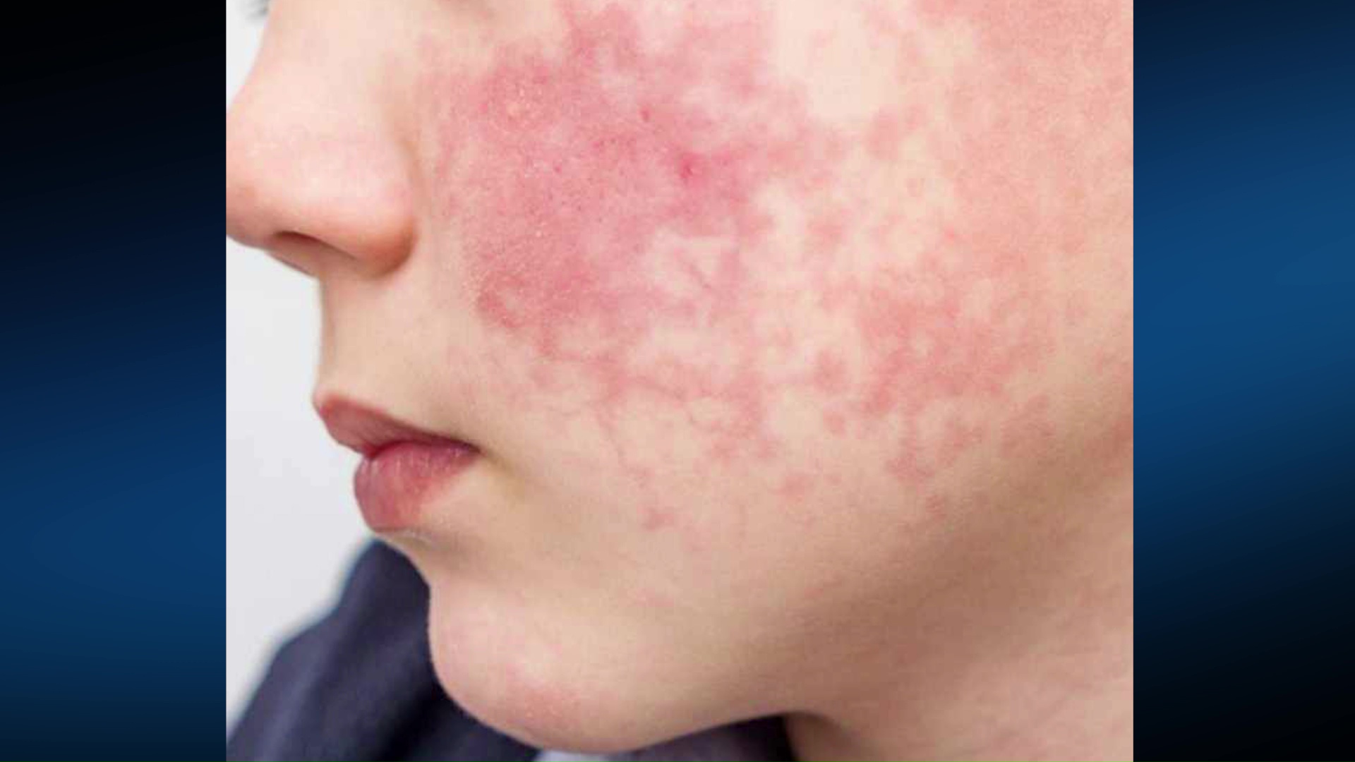 Зачестени случаи на вирусна инфекција на кожата која се појавува по ...