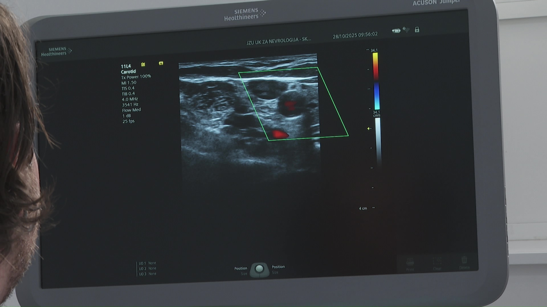 Годишно во Македонија има по пет илјади мозочни удари – не се поштедени ниту децата