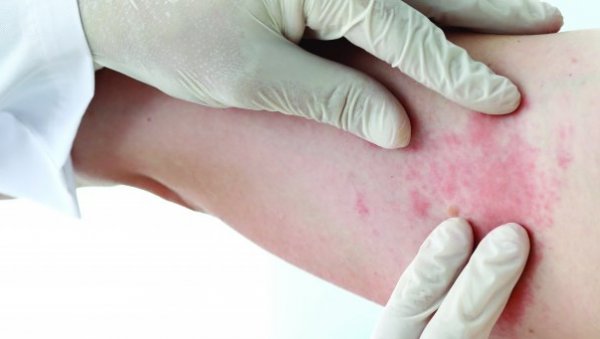 Во Република Српска потврден случај на тифус кај студентка од Индија