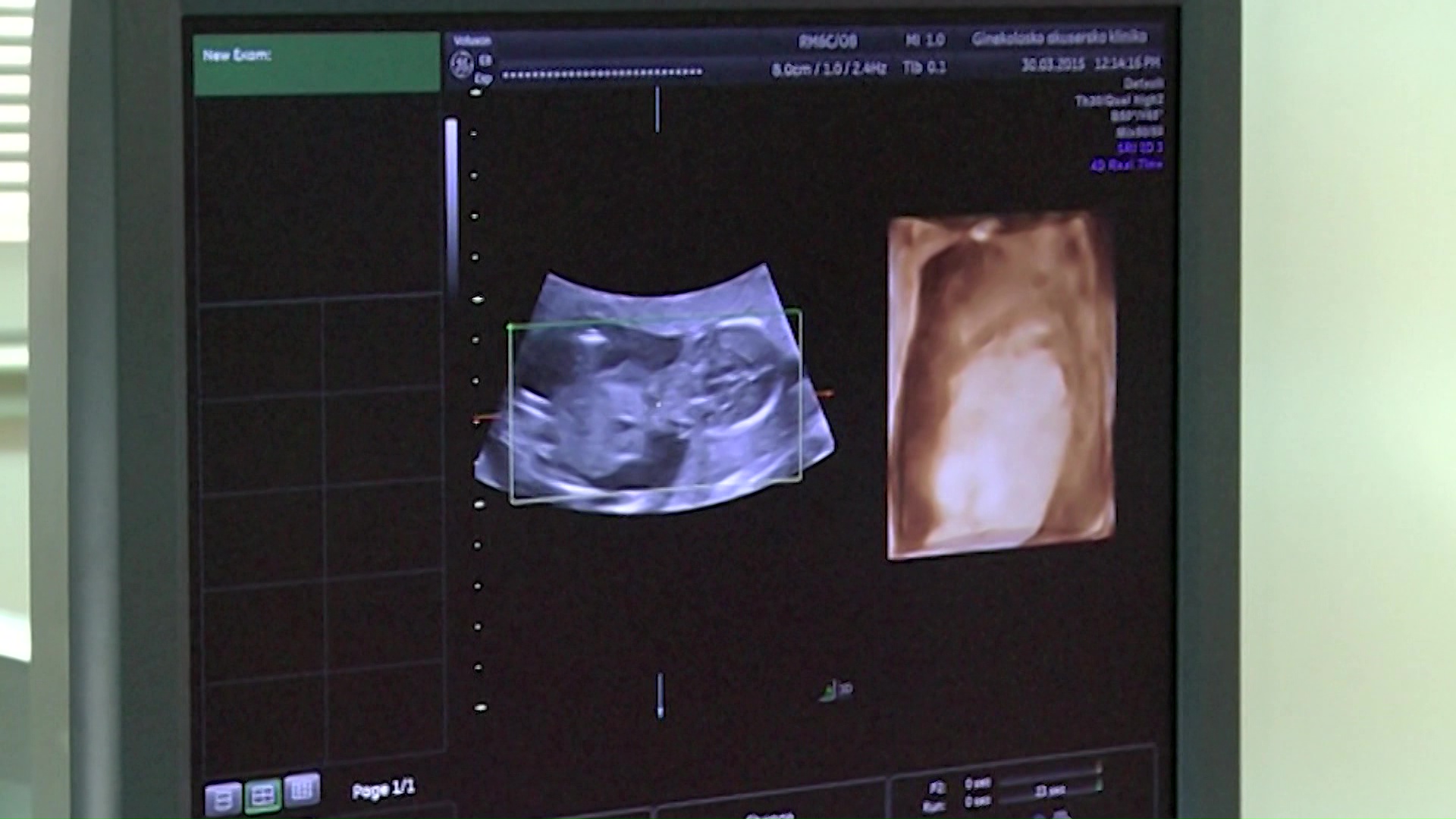 Ново истражување: Нема поврзаност меѓу земање „Парацетамол“ во бременоста и појава на аутизам кај децата