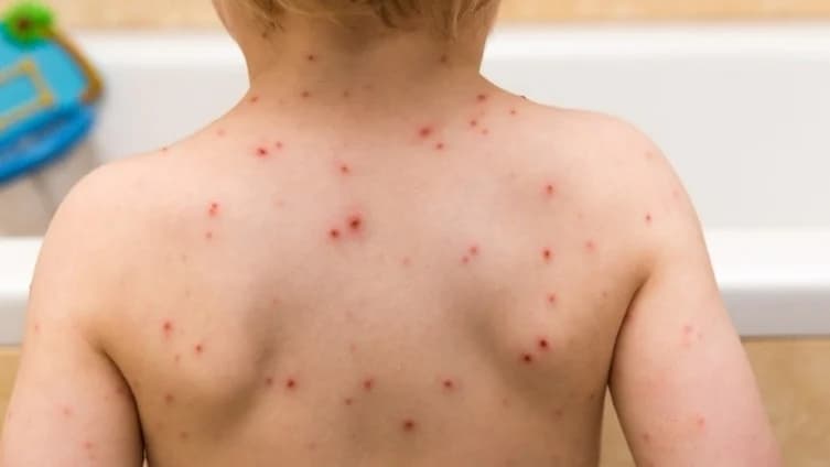 Еуроњуз: Шест европски земји го загубија статусот на земји без мали сипаници додека случаите нагло растат низ целиот континент