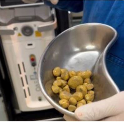 Истражување: Научници открија бактерии во бубрежни камења