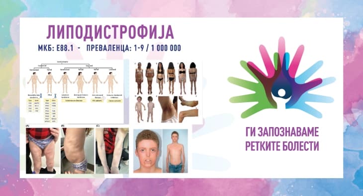 „Ги запознаваме ретките болести“: Липодистрофија