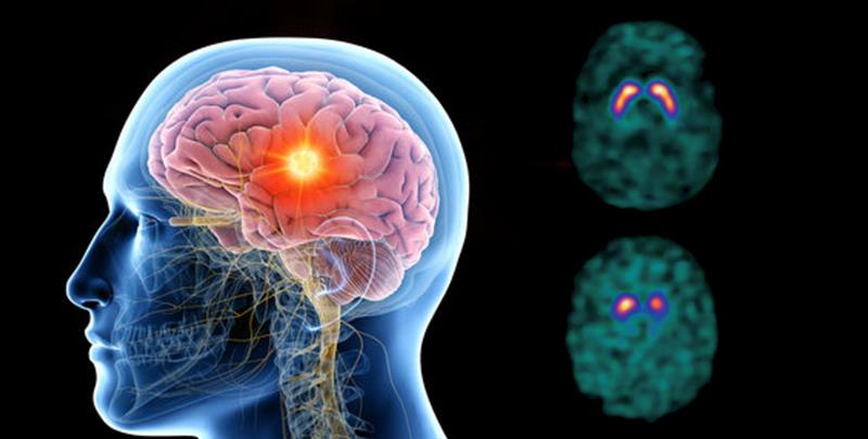 Светот го одбележува Денот на епилепсијата