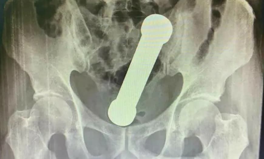 Се жалел на неподносливи болки во стомакот- докторите од ректумот му извадиле метален тег од 2 килограми