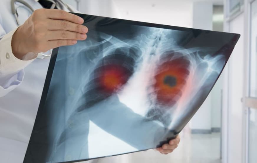 Белите дробови „пукаат“ како пуканки- руските доктори дефинираа нови симптоми на тешка болест