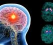 Напредок во третманите за епилепсија со длабока мозочна стимулација