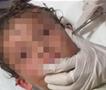 Кошмар за секој родител: Докторите вадат жив рак од уво на мало дете (ВИДЕО)