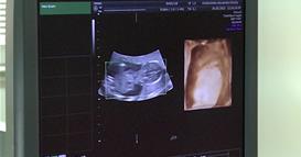 Ново истражување: Нема поврзаност меѓу земање „Парацетамол“ во бременоста и појава на аутизам кај децата