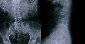 Се жалел на страшни болки во стомакот- докторите занемеле кога виделе што има внатре 