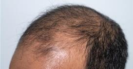 Научниците открија нов гел за борба против ќелавоста