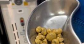 Истражување: Научници открија бактерии во бубрежни камења