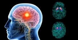 Светот го одбележува Денот на епилепсијата