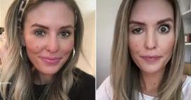 Меѓу естетиката и ризикот – какви последици може да предизивикаат ботокс третманите?  