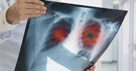 Белите дробови „пукаат“ како пуканки- руските доктори дефинираа нови симптоми на тешка болест