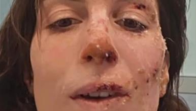 Елеонора го преживеа ужасот во барот во Кран Монтана- ги покажа раните и раскажа како преживеала (ВИДЕО)