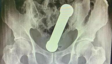 Се жалел на неподносливи болки во стомакот- докторите од ректумот му извадиле метален тег од 2 килограми 