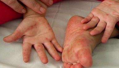 Педијатрите дневно дијагностицират од три до 4 деца со коксаки вирус