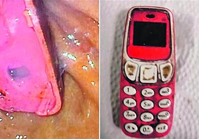 Косовец проголтал Нокиа 3310, се пожалил дури по 4 дена, па му ја извадиле (ФОТО)