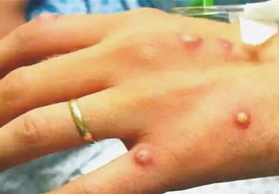 СЗО: 780 случаи на мајмунски сипаници во 27 држави, бројот сигурно е поголем
