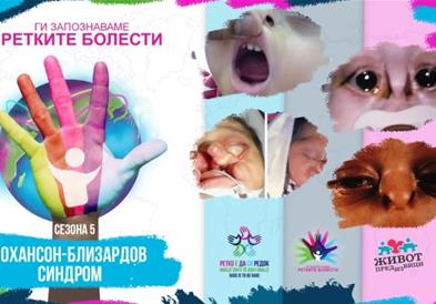 „Ги запознаваме ретките болести 2023“: Јохансон-Близардов синдром