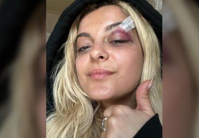Бебе Раџа покажа како изгледа, откако среде концерт во Њујорк ја погодија со мобилен (ВИДЕО)