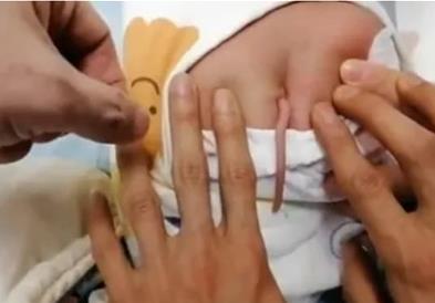 Бебе се родило со опашка, долга 10 сантиметри- докторите имаат објаснување (ВИДЕО)