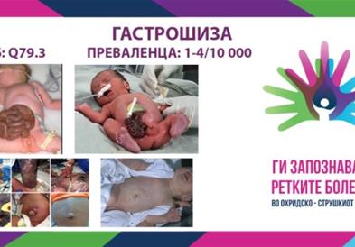 „Ги запознаваме ретките болести“ - Гастрошиза