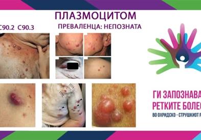 „Ги запознаваме ретките болести“ - Плазмацитом