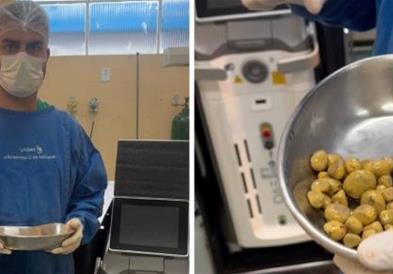 35 бубрежни камења  отстранети кај човек кој секој ден пиел по 3 литрa газирани пиjaлоци