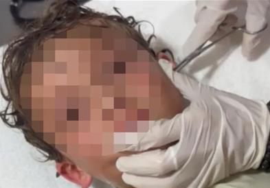 Кошмар за секој родител: Докторите вадат жив рак од уво на мало дете (ВИДЕО)