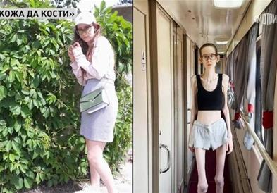 Aнастасија има само 29 килограми на 176 см висина: „Бев еднаш заљубена, но не смеев да признаам“