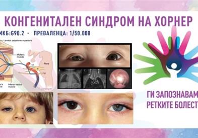 „Ги запознаваме ретките болести“: Конгенитален синдром на Хорнер