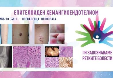 „Ги запознаваме ретките болести“: Епителоиден хемангиоендотелиом