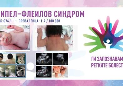 „Ги запознаваме ретките болести“: Клипел-Флеилов синдром/Синдром на цервикална фузија на пршлените