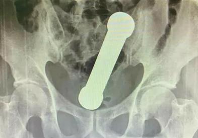 Се жалел на неподносливи болки во стомакот- докторите од ректумот му извадиле метален тег од 2 килограми 