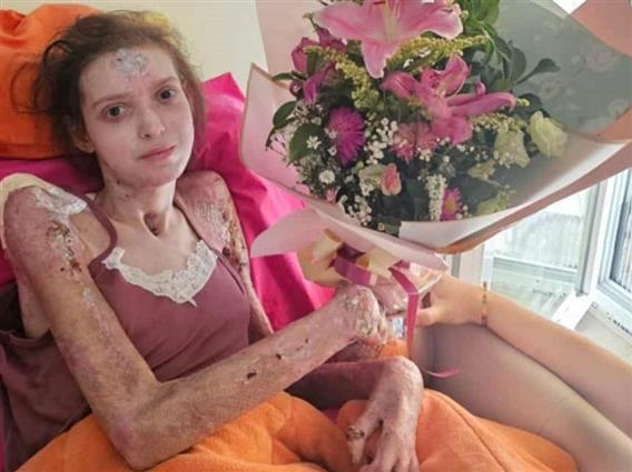 Мелани Тасева се врати дома- најтешко повредената во пожарот во „Пулс“ се избори за живот