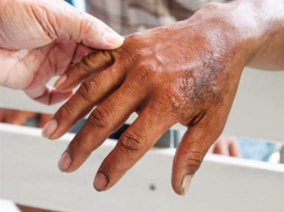 Во Хрватска е потврден прв случај на лепра