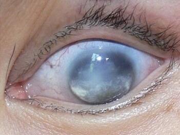 Првпат во историјата: Вирус од морски животни премина на луѓе и предизвикува сериозни проблеми со видот