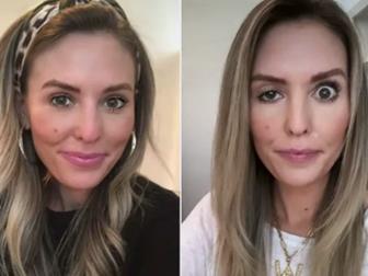 Меѓу естетиката и ризикот – какви последици може да предизивикаат ботокс третманите?  