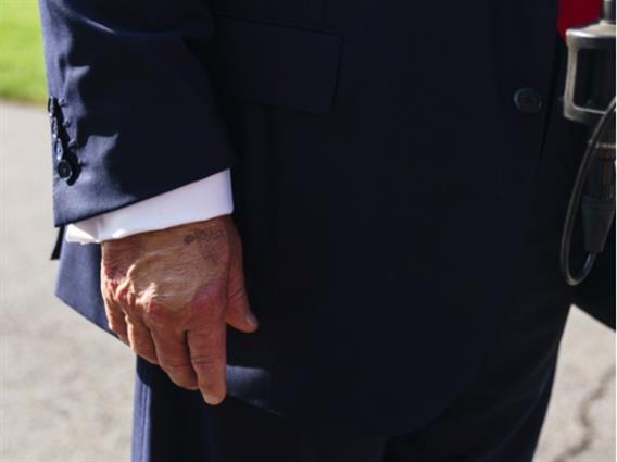 Трамп оди на лекарски преглед, негови фотографии со модринки се шират на интернет