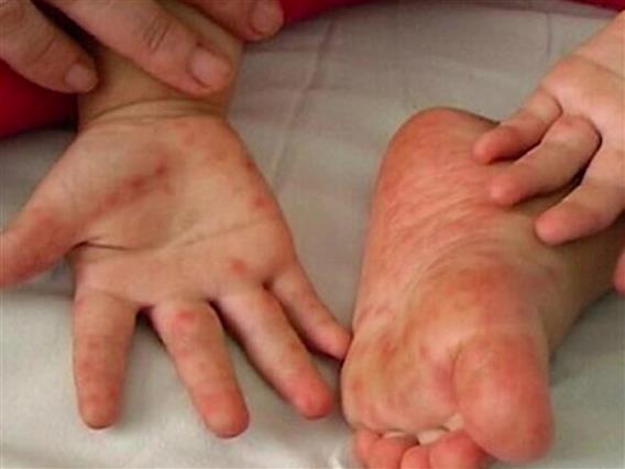 Педијатрите дневно дијагностицират од три до 4 деца со коксаки вирус