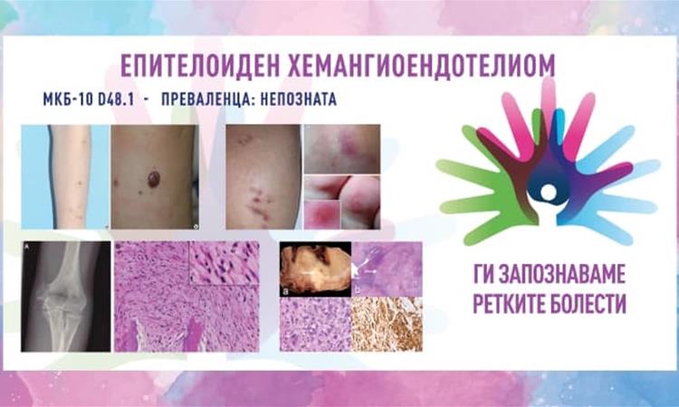 „Ги запознаваме ретките болести“: Епителоиден хемангиоендотелиом