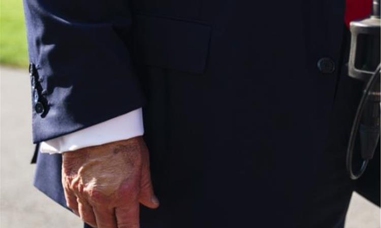 Трамп оди на лекарски преглед, негови фотографии со модринки се шират на интернет