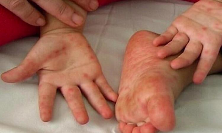 Педијатрите дневно дијагностицират од три до 4 деца со коксаки вирус