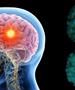 Напредок во третманите за епилепсија со длабока мозочна стимулација