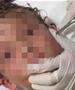 Кошмар за секој родител: Докторите вадат жив рак од уво на мало дете (ВИДЕО)
