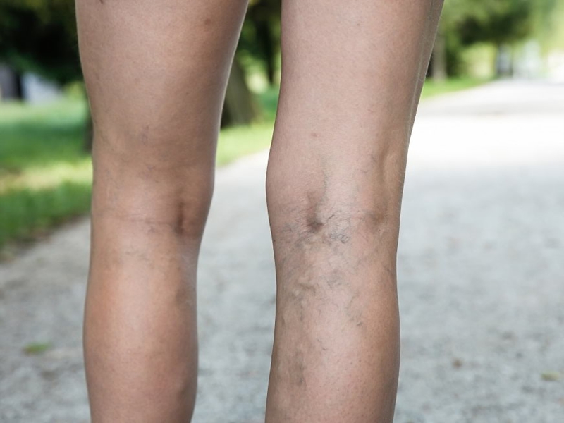 Пациентите бараат скапите лекови за тромбоза да се најдат на позитивна листа 