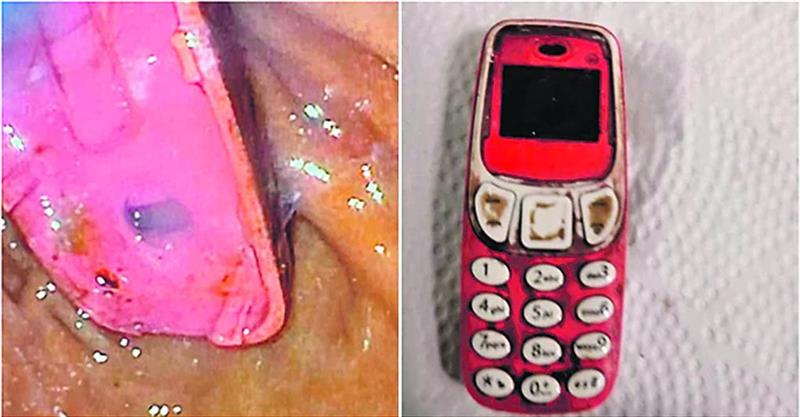 Косовец проголтал Нокиа 3310, се пожалил дури по 4 дена, па му ја извадиле (ФОТО)