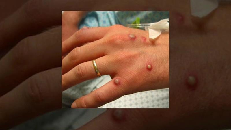 Сомнителен случај на мајмунски сипаници во Грција
